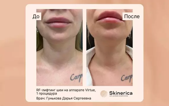 RF-лифтинг шеи аппаратом Virtue. Гунькова