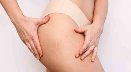 Целлюлит